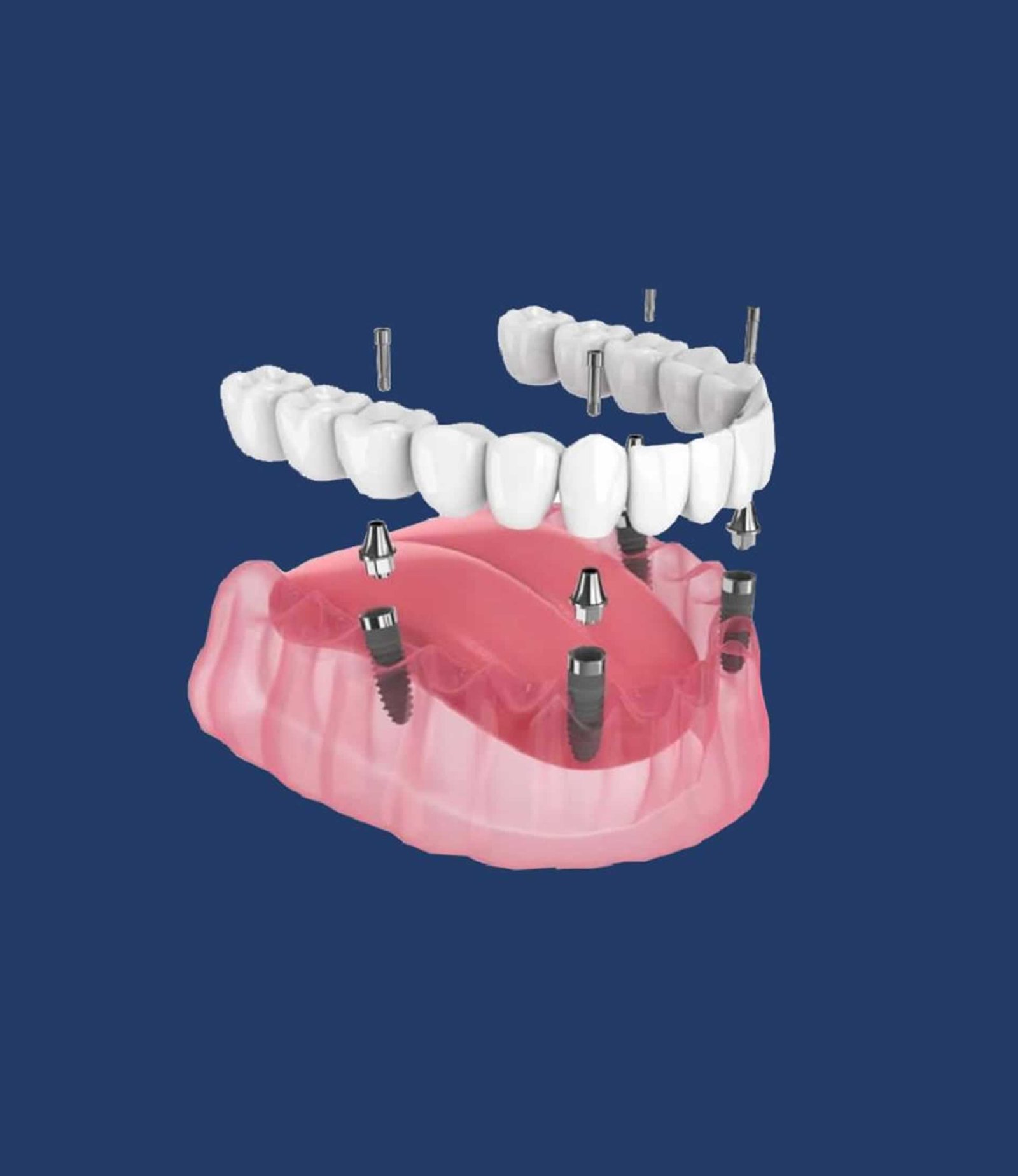Prótesis dentales