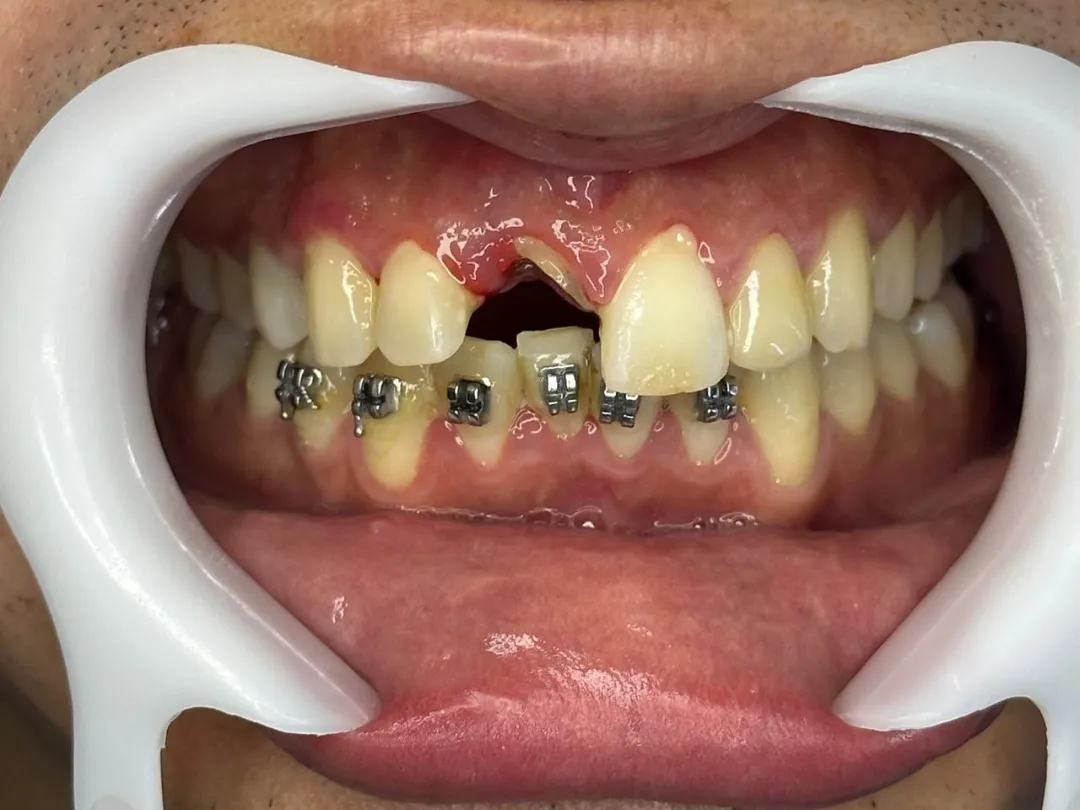 Caso real antes de implante dental en sector anterior - COAM